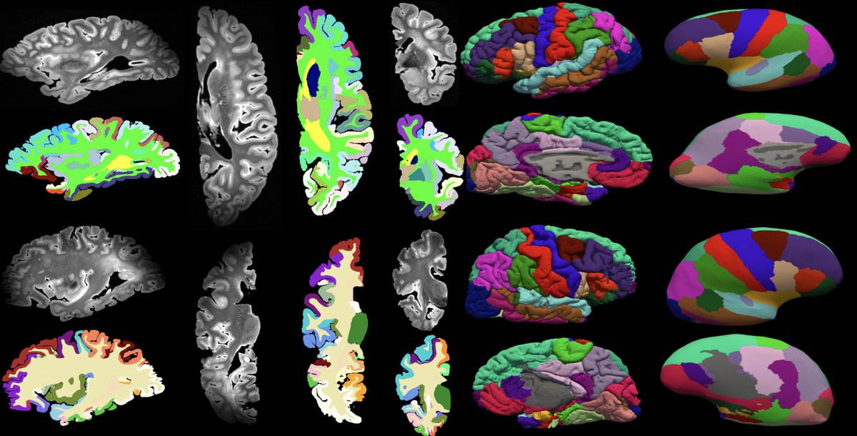 Excited to share our surface-based pipeline to parcellate 7T ex vivo postmortem human brain MRI at sub-millimeter native subject space resolution. We perform vertex-wise analysis in template space to link morphometry with histopathology! Paper: arxiv.org/abs/2403.19497 🧵(1/6)
