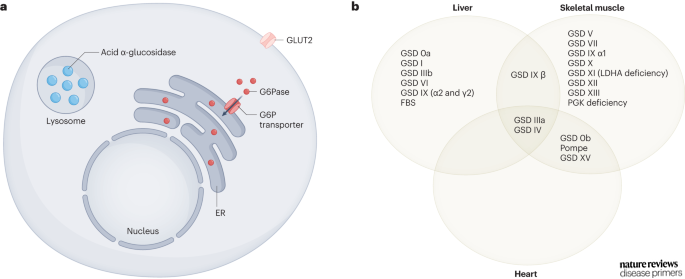 DiseasePrimers's tweet photo. #Fanconi–Bickel syndrome is caused by pathogenetic variants in SLC2A2, which encodes the #GLUT2 transporter https://t.co/glKeqzPpTD https://t.co/x01551H8HY