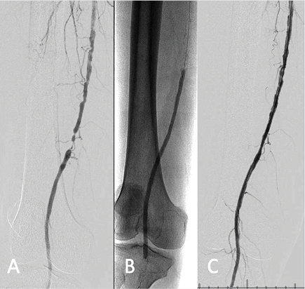 The HawkOne™ Directional Atherectomy System Puts Control in the Hands of the Operator CLD talks with Michael J. Paisley, MD, and Brant W. Ullery, MD, MBA, FACS, FSVS. okt.to/mE2iXe #PAD #PVD #cardiotwitter @BrantUllery