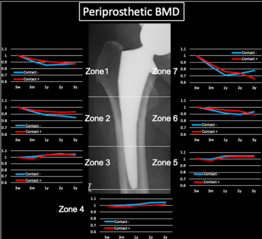 The presence or absence of contact between the medial collar and femoral neck did not affect postoperative BMD changes or radiological or clinical results. authors.elsevier.com/a/1igpO38vD3A2…