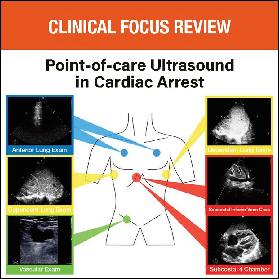 Authors explain the role of point-of-care ultrasound in cardiac arrest rhythm classification and the diagnosis of reversible causes, discuss protocols for applications to Advanced Cardiac Life Support, and summarize principles for implementation: ow.ly/PitQ50R53Xc