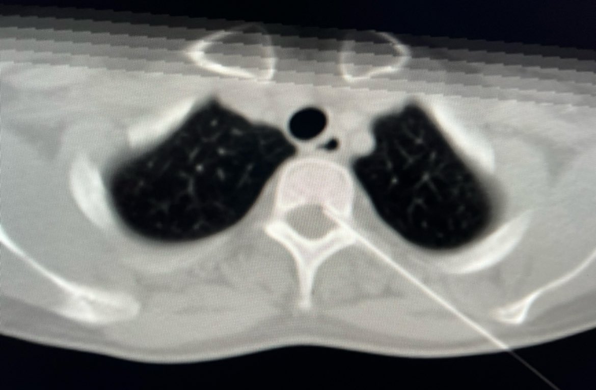 Tad Maguire (@irtmke) on Twitter photo Given surgical risks/morbidity, ventral epidural fibrin + blood patch performed at level of dural injury. Leak resolved, symptoms improved. Recovery complicated by rebound intracranial hypertension, medically managed. 
CSF leaks are difficult to dx & tx. Likely under-dx Given surgical risks/morbidity, ventral epidural fibrin + blood patch performed at level of dural injury. Leak resolved, symptoms improved. Recovery complicated by rebound intracranial hypertension, medically managed. 
CSF leaks are difficult to dx & tx. Likely under-dx