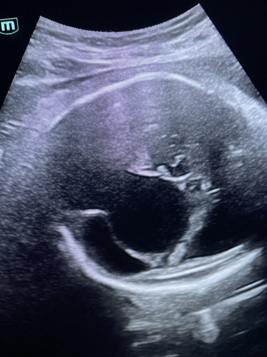 Vein of Galen aneurysm: One third have a good outcome after postnatal intervention by embolization. One third die during the procedure and one third survive but with neurodevelopmenal delay. If there is hydrops fetalis at the time of diagnosis then the prognosis is poor.