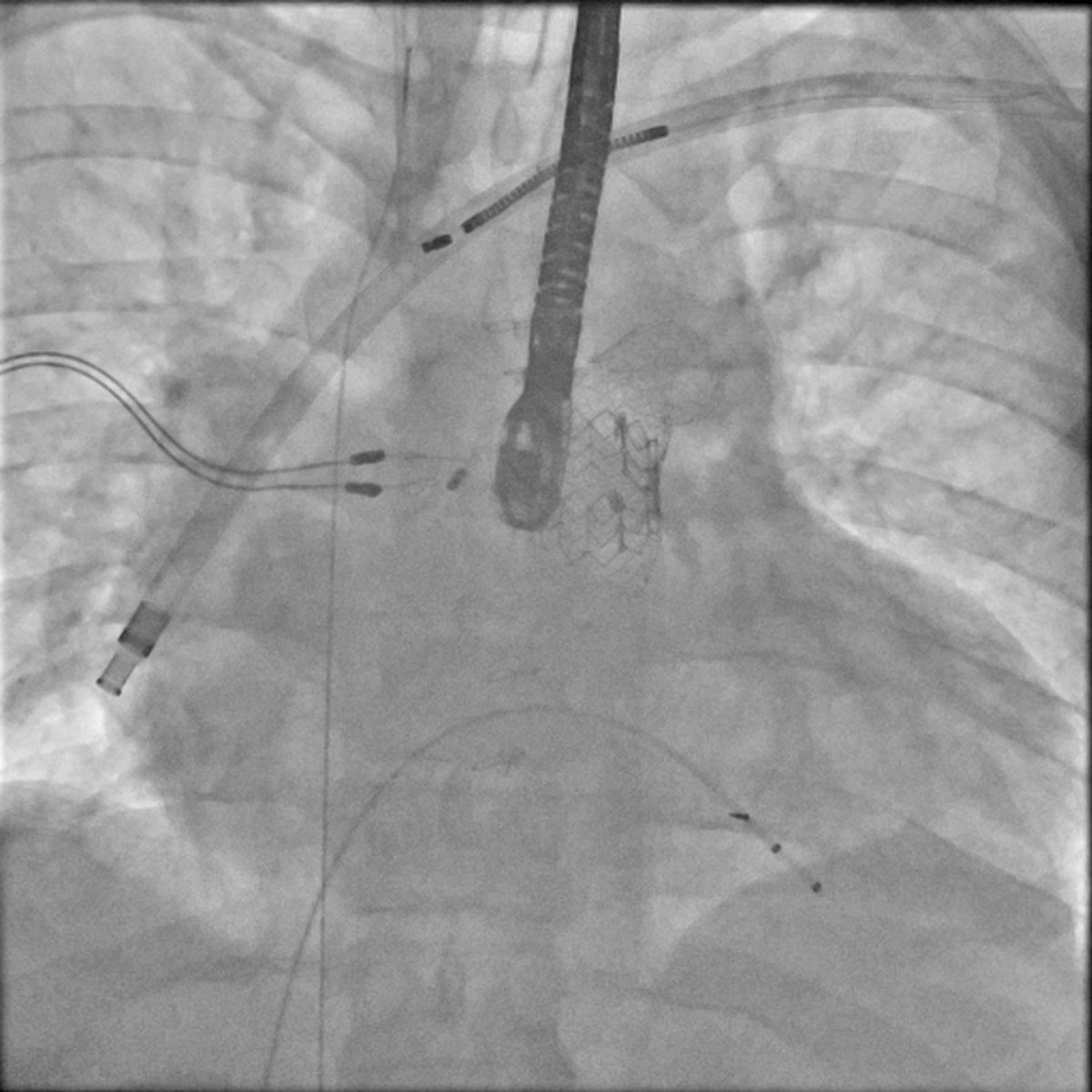 Mechanical rotational TLE in GUCH patient for infection. Dual chamber ICD (dual coil, passive fixation), dwell time 12 years.