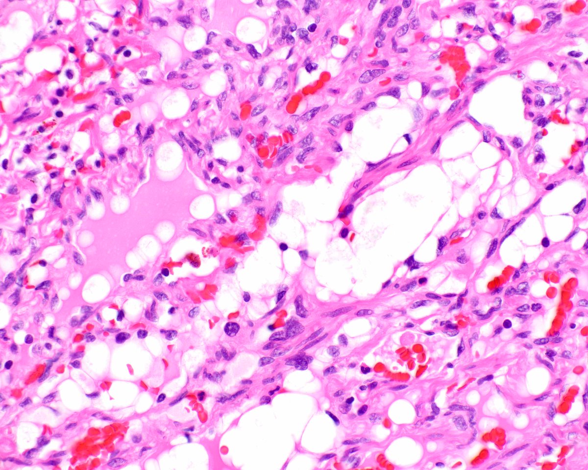 A splendid spindle cell hemangioma. These were initially reported as spindle cell hemangioendothelioma but additional data indicated otherwise. They are associated with the Maffucci syndrome (multiple enchondromas). #UMiamiPath