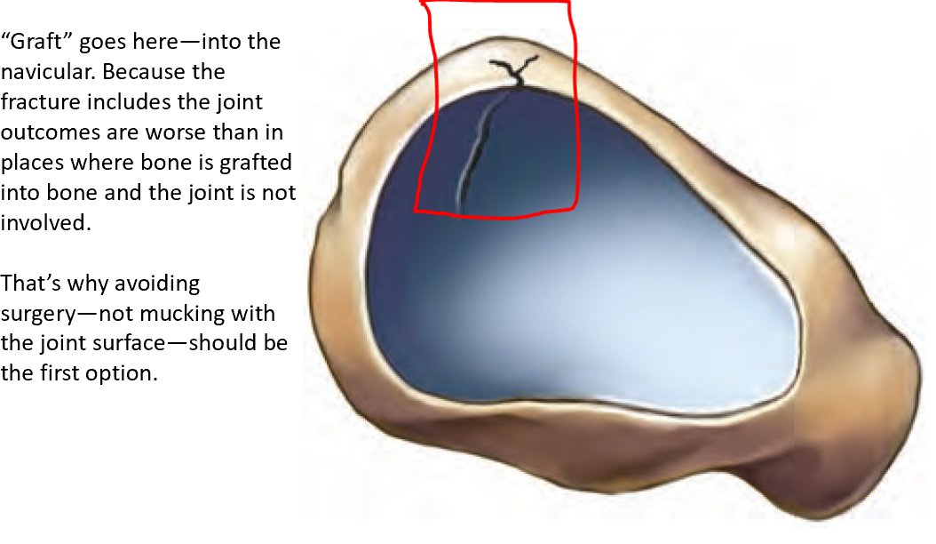 Heard about a patient considering surgery as first line for navicular stress fracture. Wouldn't be my choice: Here's why. bit.ly/3vzE9bv
Let me know if I'm wrong--happy to amend the blog. #SharedDecisionMaking k2