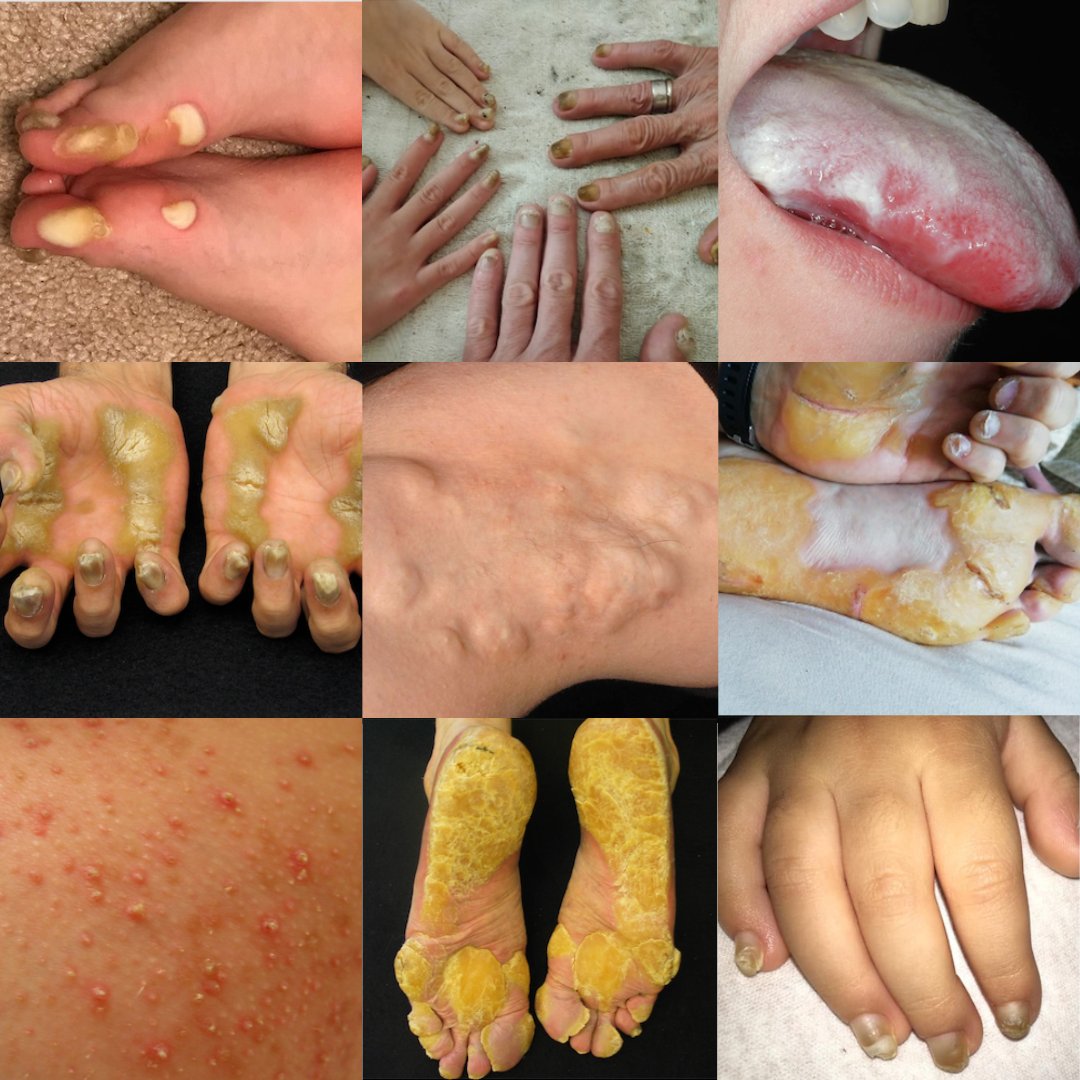 Edel O'Toole (@edelotoole) on Twitter photo Delighted to see the Pachyonychia Congenita Research Agenda in the April 2024 <a href="/theJIDJournal/">Journal of Investigative Dermatology</a> <a href="/Pachyonychia/">PC Project</a> <a href="/lifearc1/">LifeArc</a> #RareDisease jidonline.org/article/S0022-… Delighted to see the Pachyonychia Congenita Research Agenda in the April 2024 <a href="/theJIDJournal/">Journal of Investigative Dermatology</a> <a href="/Pachyonychia/">PC Project</a> <a href="/lifearc1/">LifeArc</a> #RareDisease jidonline.org/article/S0022-…