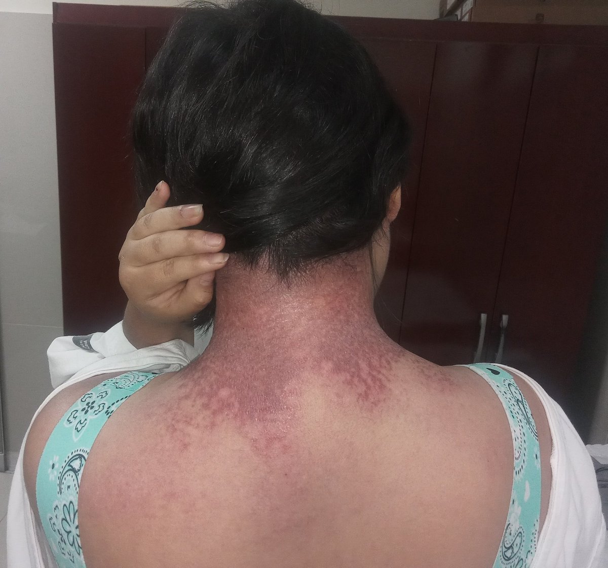ConsejosReumato's tweet photo. La #dermatomiositis afecta el #músculo y la #Piel , entre los hallazgos dérmicos tenemos el #heliotropo , pápulas de #Gottron , signo de V en tórax anterior y signo del "manto o chal" en la parte posterior del #cuello y región superior del dorso como se aprecia en la foto. #skin https://t.co/yzd3TkH7iT