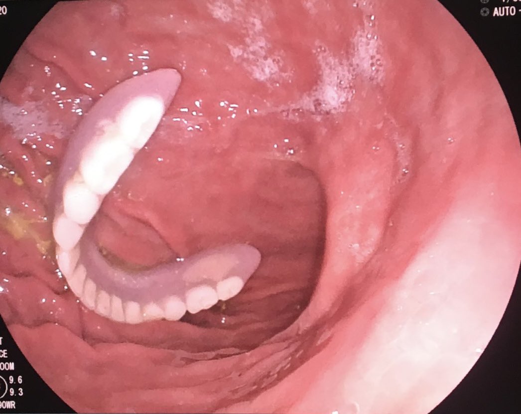 Unusual finding in the stomach. How should this be managed?