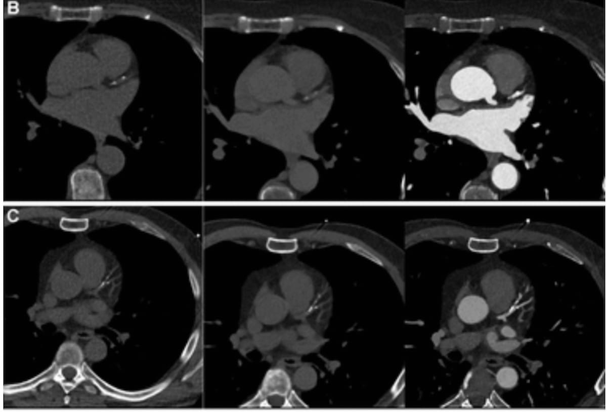 Could Virtual Non-Contrast Images from Photon-Counting CT Reduce Radiation Dosing with CCTA? diagnosticimaging.com/view/virtual-n… @ACRRFS @ACRYPS @RadiologyACR @ARRS_Radiology @SIRspecialists @Heart_SCCT @DukeRadiology @PennRadiology @OSURadiology @YaleRadiology #radiology #RadRes #CTRad