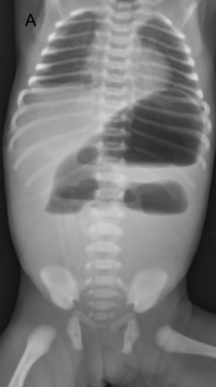 Neonate brought on day 2 of life with bilious vomiting and abdominal distension. Likely diagnosis?