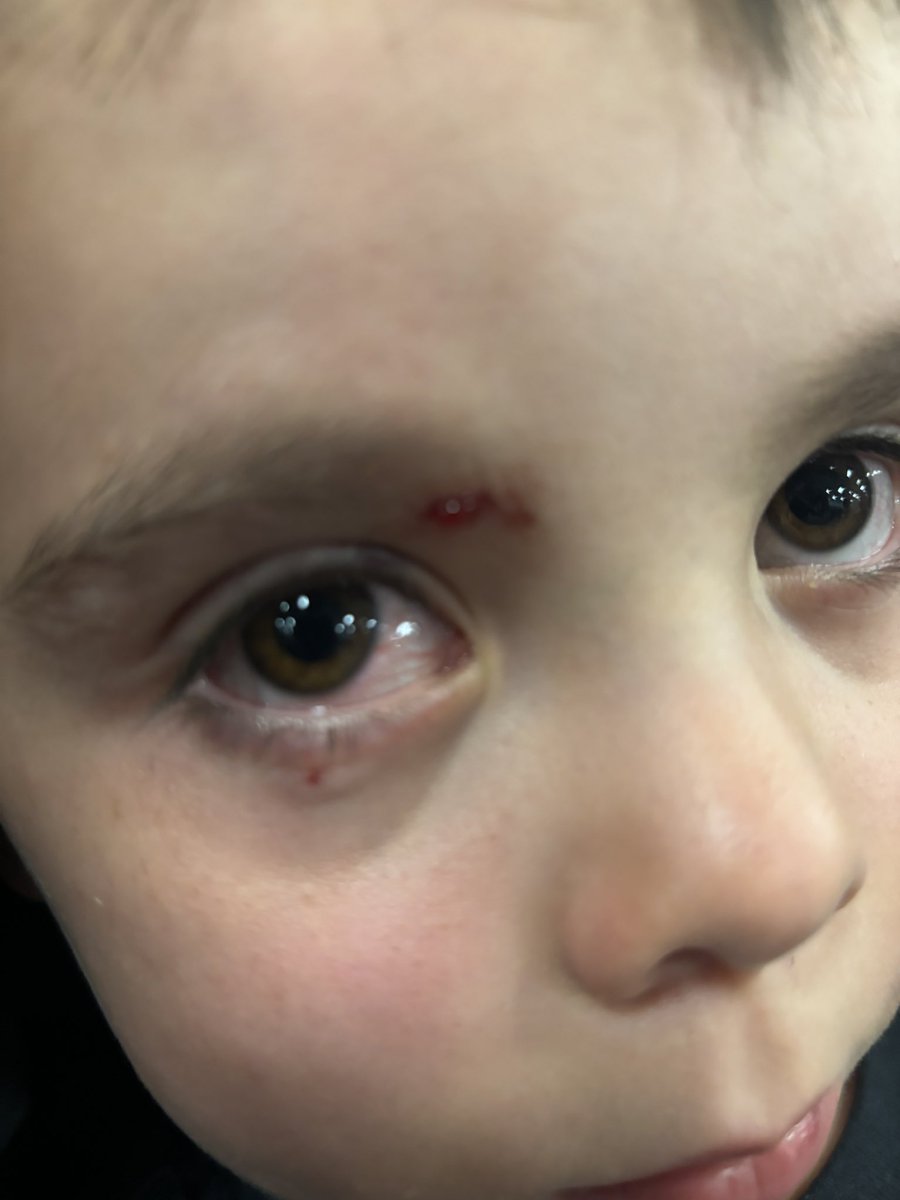 No pensé que el #AICM fuera PELIGROSO. 
Me quejaba de que no hay agua, atrasos, pena de lo feo que está, migración lenta, etc. Pero no de peligros. 
Hoy mi hijo se lastimó el ojo al pegarse con un barandal. Esto fue en T2 pasando migración, en la rampa del desnivel