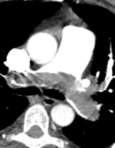 PE risk stratification is all about hemodynamics, clot size doesn’t matte 😳