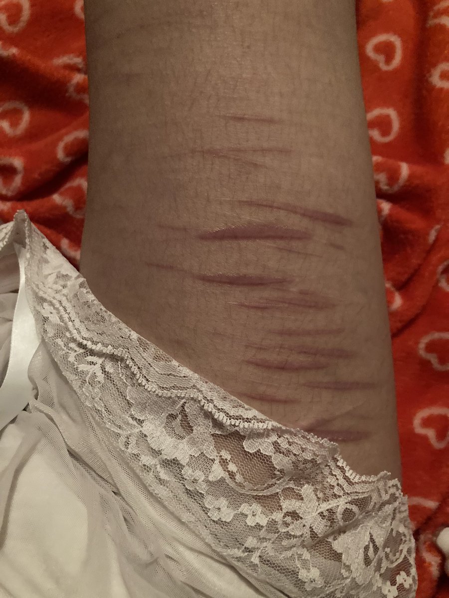 s1utbucket's tweet photo. trying to gaslight myself into believing my scars are cute bc i have to live w them forever now lol https://t.co/2z8nwEbjFg