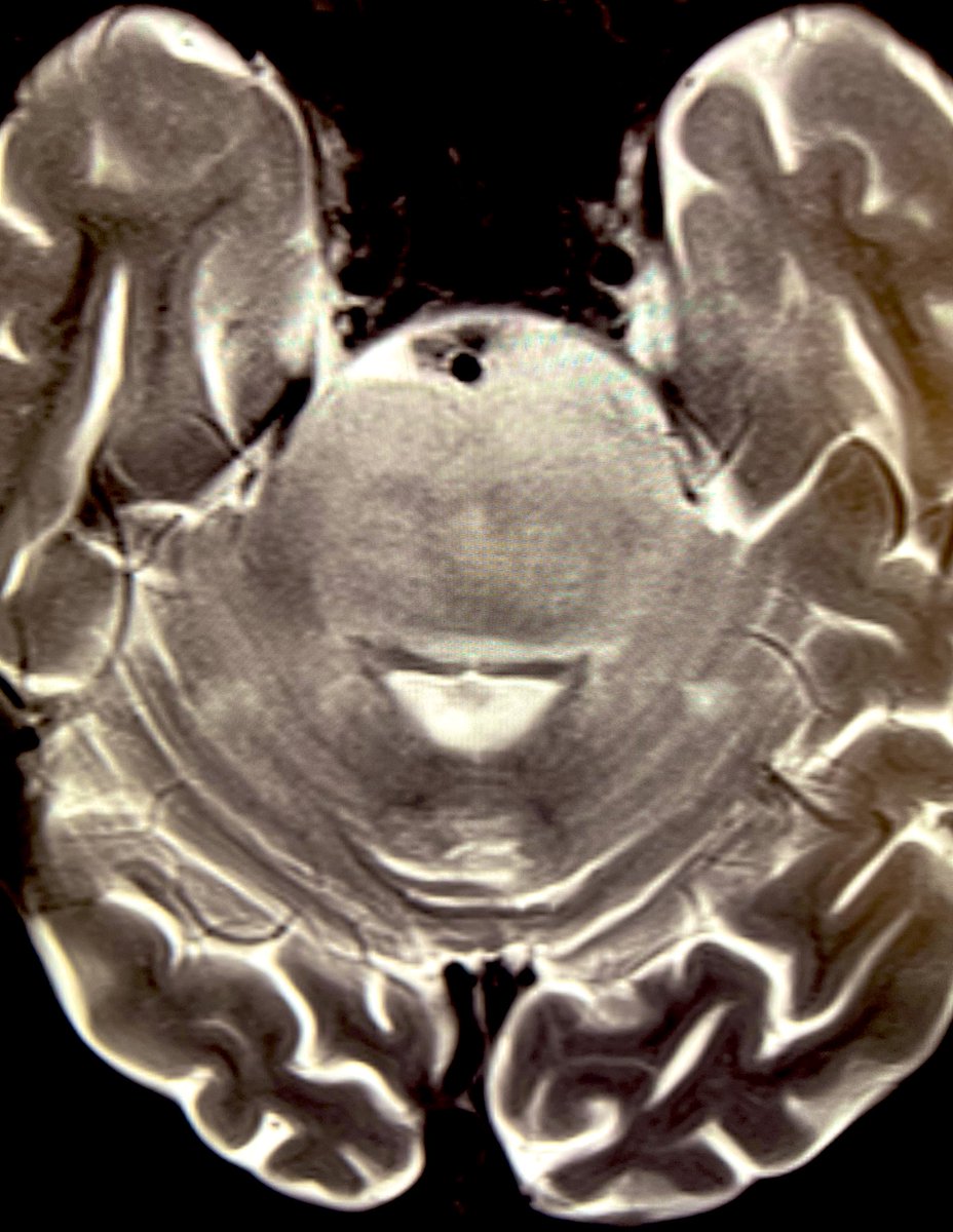 Tip of the day 💡: Diffuse Midline Glioma can spread into the cerebellar hemispheres from their brainstem epicenter. This weekend, be thorough and keep your awareness sharp.