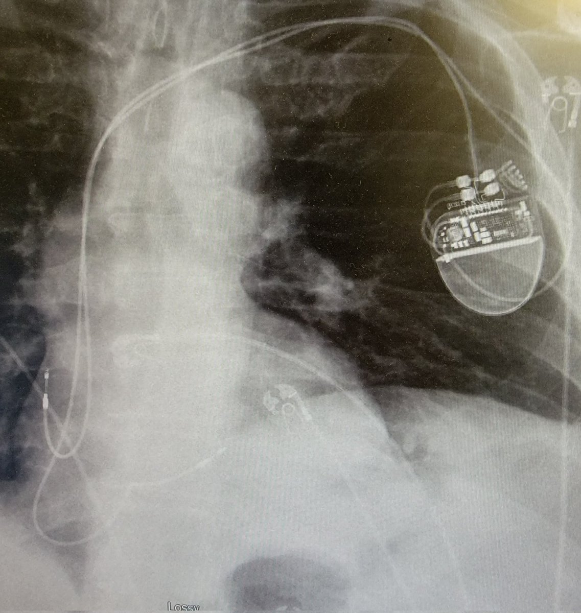 DC-PPM placed for CHB 4 years ago referred for CRT upgrade for EF 45%. Normal device function. Always look at the CXR! Where is the RV lead going? Next steps? @AZ_EP_DOC @rainylakedana @naijaQRS @BoldiKovacsMD @JasneetDevgun @muazzumshah