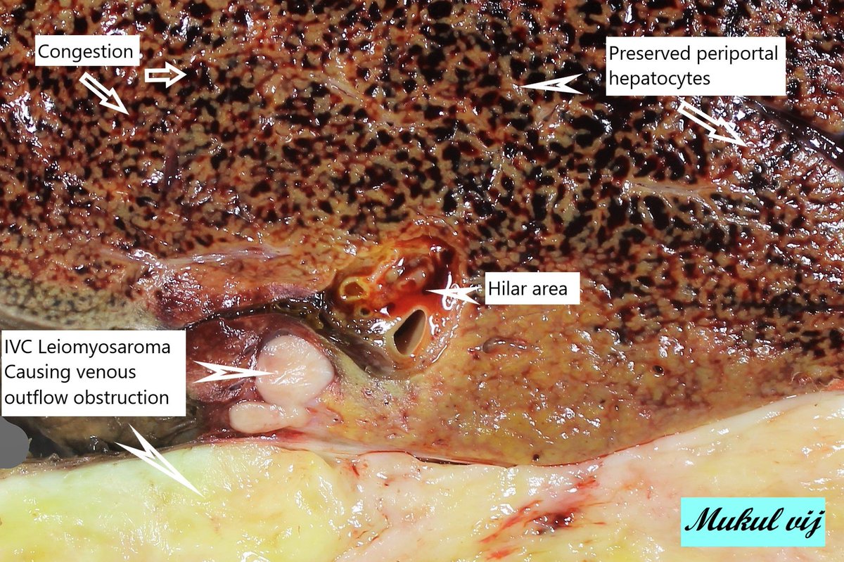 Art in Pathology #liverpath #pathx