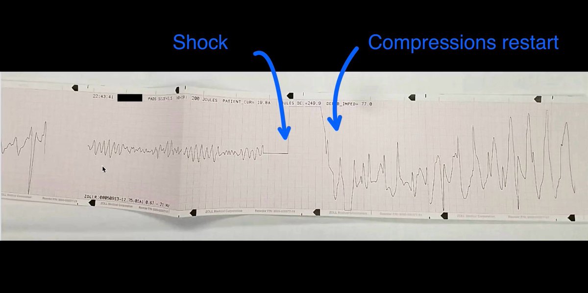 There is a second very important lesson in this case. Check out the flawless way the team restarts compressions instantly Strive to do this. Every time. If you are not compressing, prompt the person who is. It is far too easy to burn time+perfusion pressure looking at the rhythm