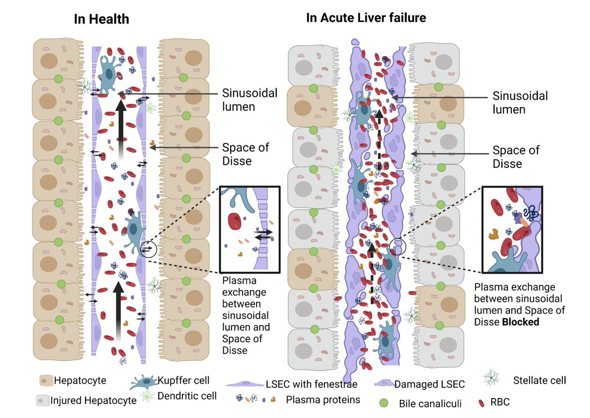 Extra-corporeal non-liver transplant therapies for acute liver failure: Focus on plasma exchange and continuous renal replacement therapy link.springer.com/article/10.100… Dr Eapen