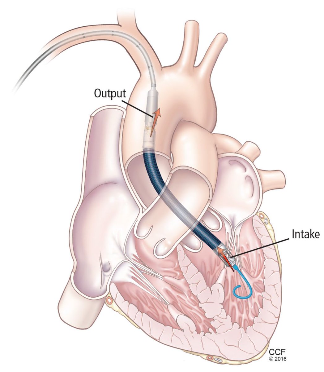 ICU Hemodynamics: I like the Impella device 👇because: 1) intensivists love toys similar to teenagers loving video games & 2) there are patients who I don't think would have any chances of survival without it (in a hospital without ECMO...) Having said this, the supporting data