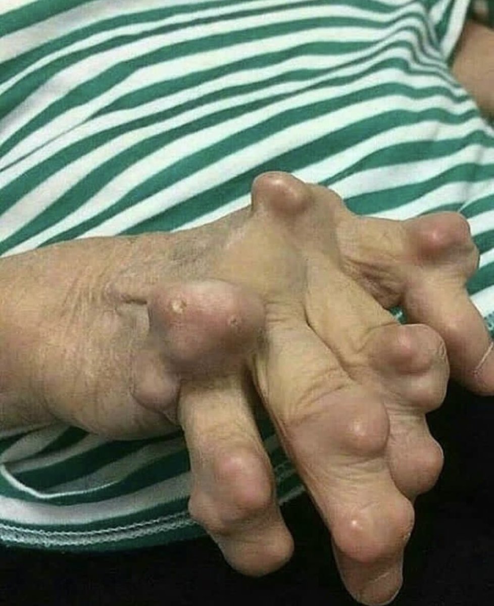 DrMedica_13's tweet photo. #Clinical_Case✨

What is your “Diagnosis?

#MedEd #Q_Pearls #MedX https://t.co/oaMJbOwrtm