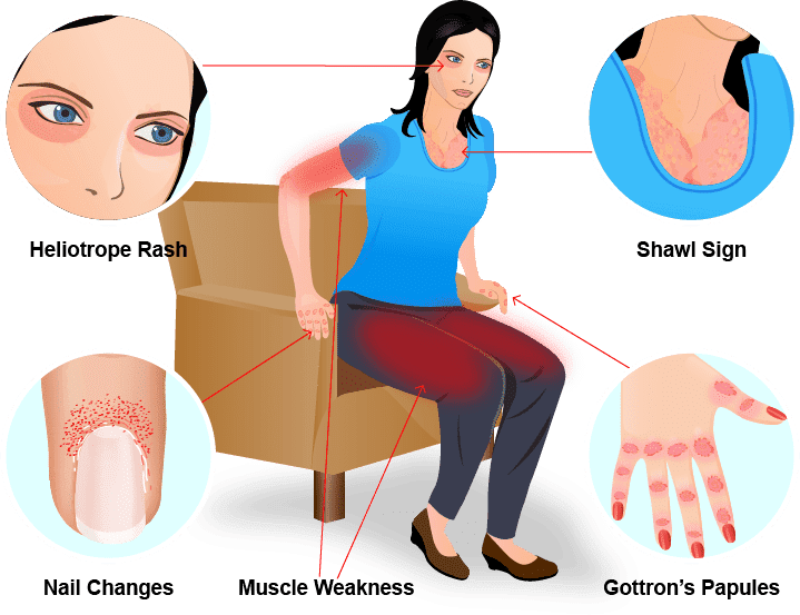 SkilledM1's tweet photo. @world_of_med1 Dermatomyositis.

This is a shawl sign. https://t.co/WdduthACX6