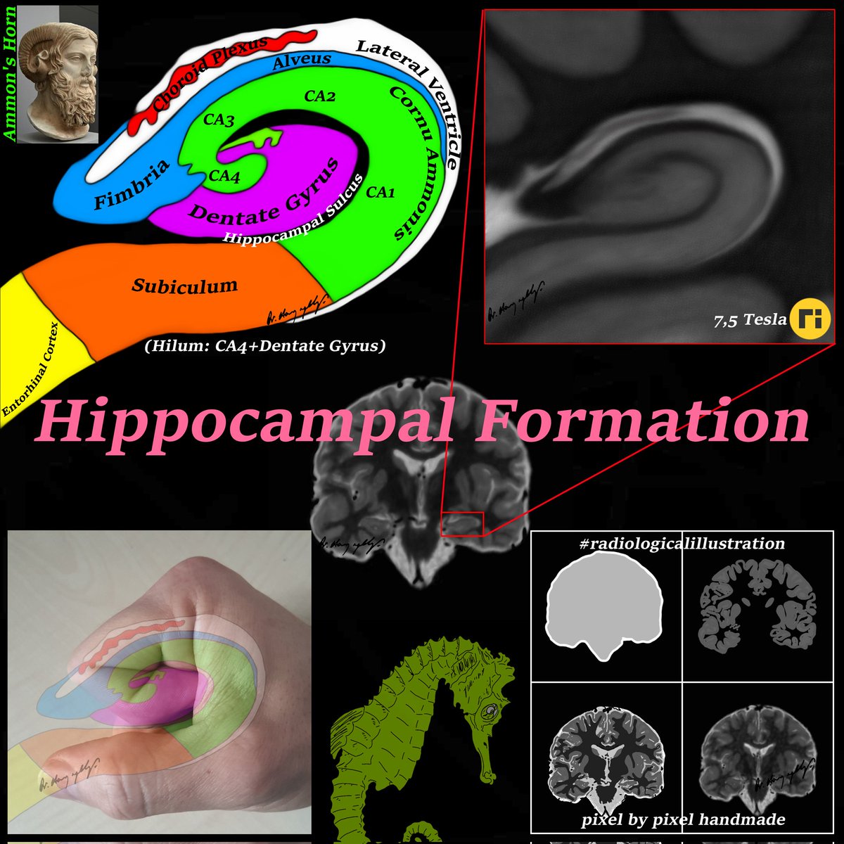 Radiologic Classification of Hippocampal Sclerosis doi.org/10.1111/epi.12… doi.org/10.3174/ajnr.A… #radiologicalillustration ✍️ pixel by pixel handmade!