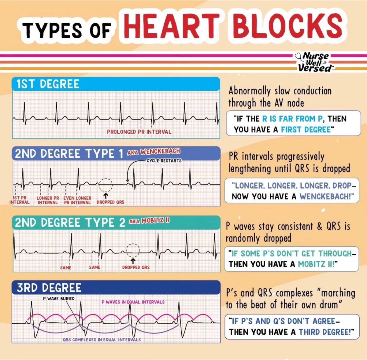 💢 Types of 🫀 Heart Blocks