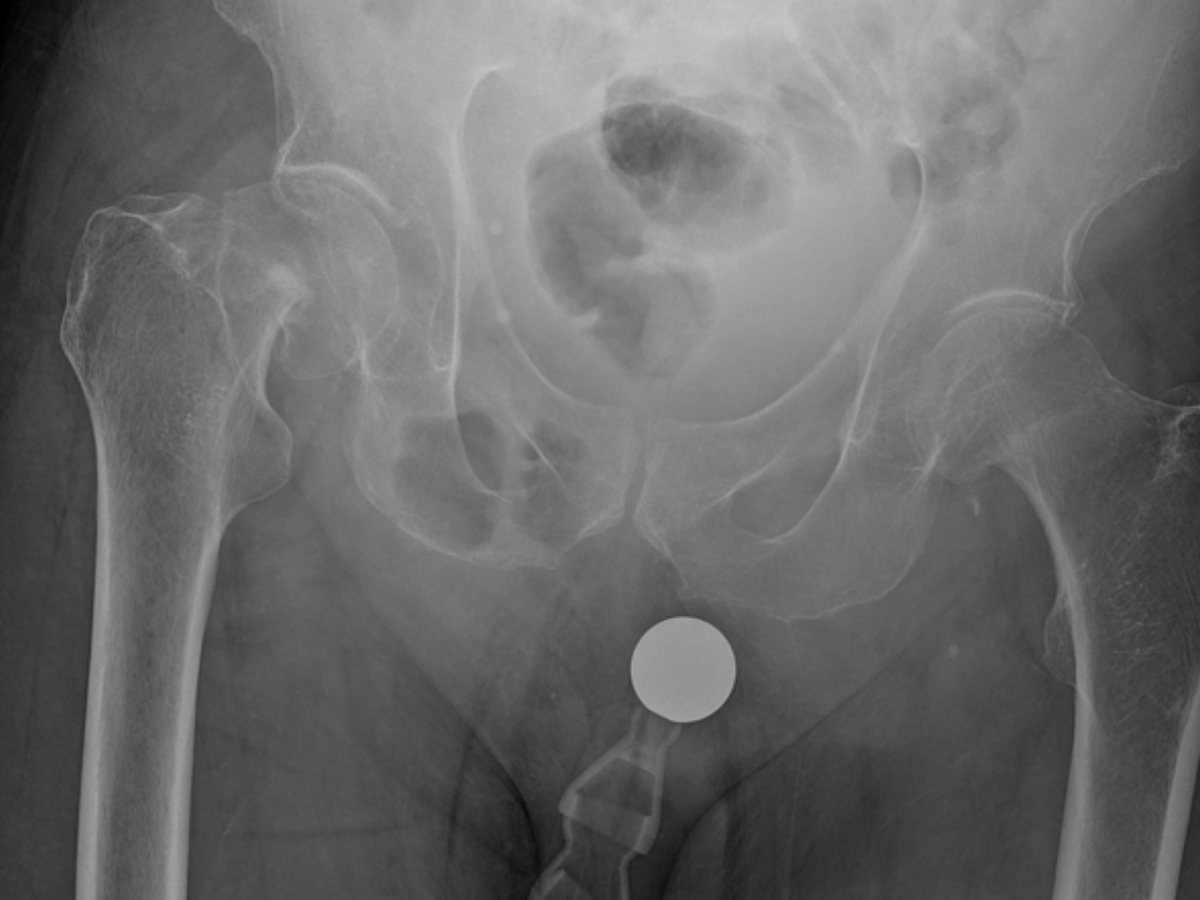 Can you spot the injuries and incidental findings on this pelvis x-ray? We'll post the full answer tomorrow (which is also the last day for HALF PRICE access to @murf1990, @docskalski & @DrAndrewDixon's new courses - don't miss out!) Thanks to @DrDLittle for this case.