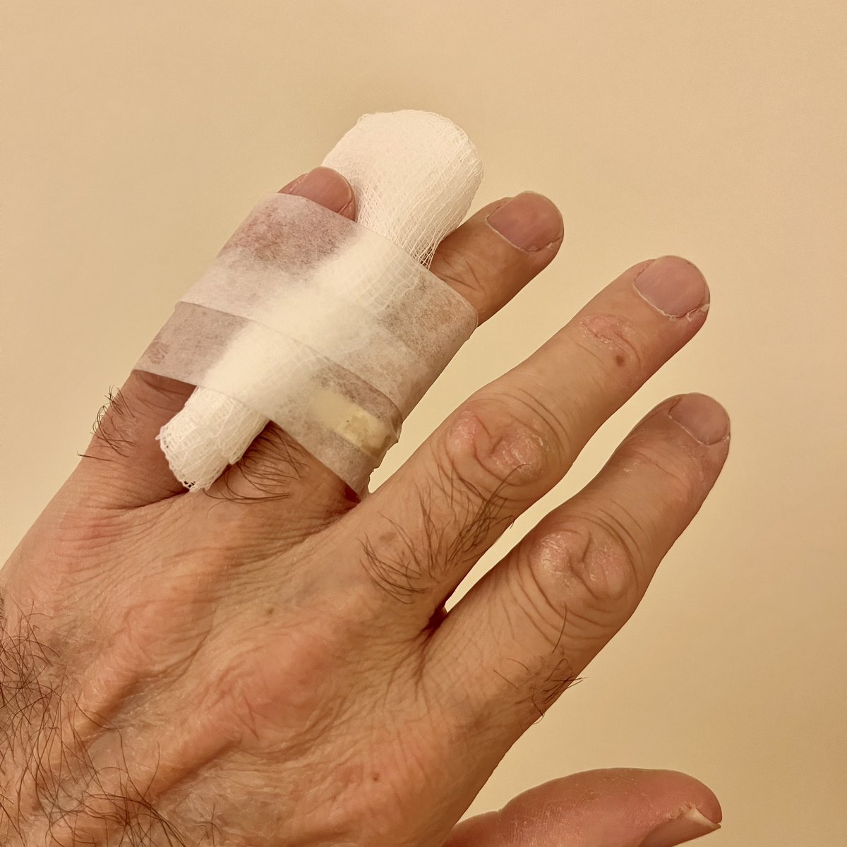 Not what any pianist wants! I dislocated my finger in a sport-related injury! Good news is that it’ll be okay but unfortunately I might have to push back the release date of my next single.