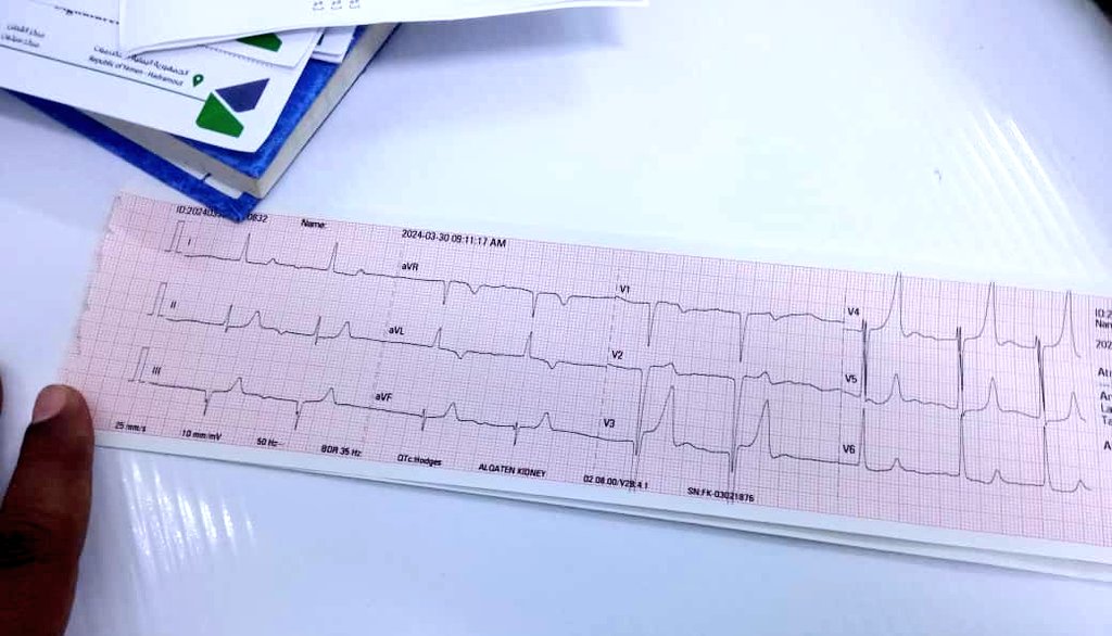 chest pain #ecg #ekg #medicalstudent #emergency #CardioTwitter #EPeeps