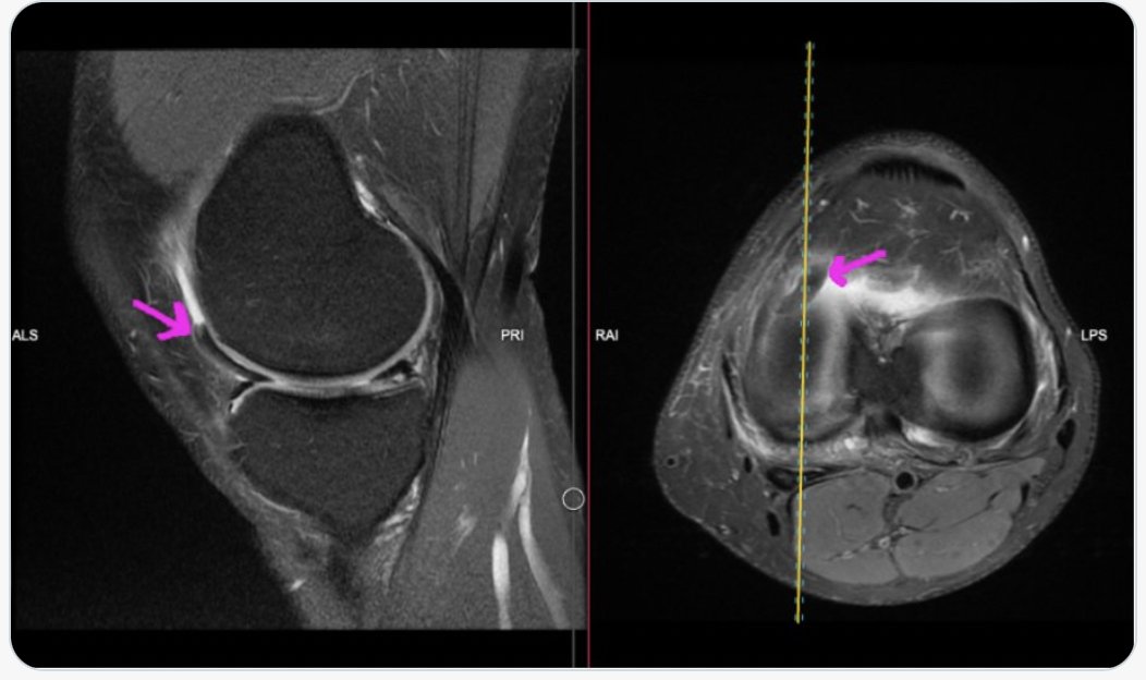 🚨 The MSK Playbook is back: Meniscus edition ! 🚨 Answer to yesterdays imaging quiz 🪣Bucket handle tear & flipped meniscal fragment 🩻Visible on the saggital and axial views The waiting list is now open for the MSK playbook Live imaging course 👇 mskplaybook.com/msk-playbook-d…