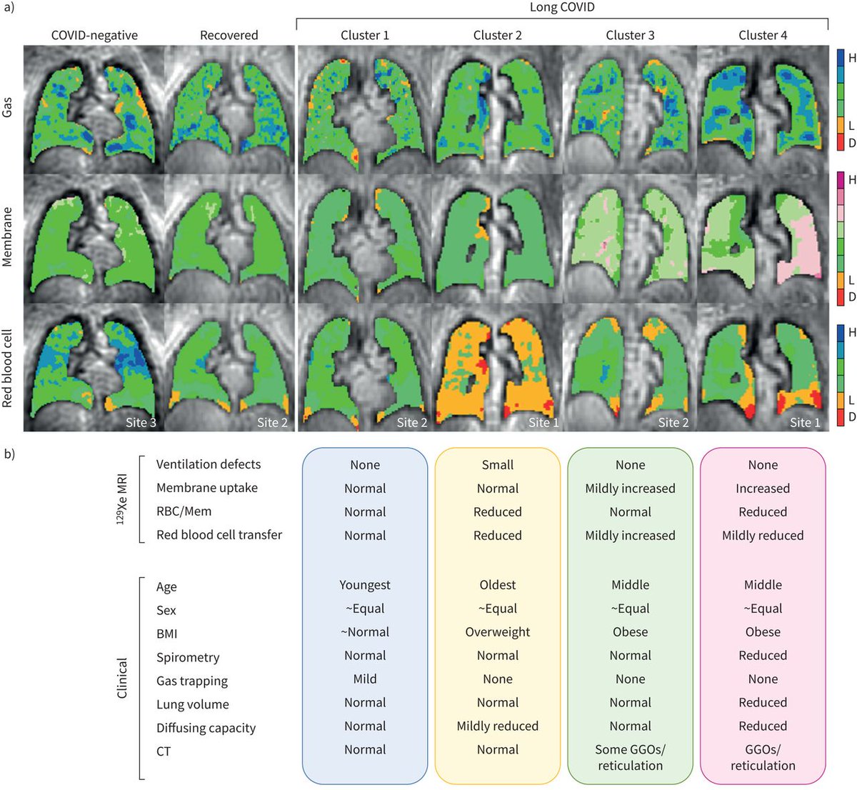 Cluster analysis of 129Xe MRI metrics identifies 4 phenotypes of long COVID with distinct functional MRI and clinical characteristics. MRI-based clusters can be used to dissect long COVID heterogeneity, enabling personalised clinical care and treatment. bit.ly/42uia1J