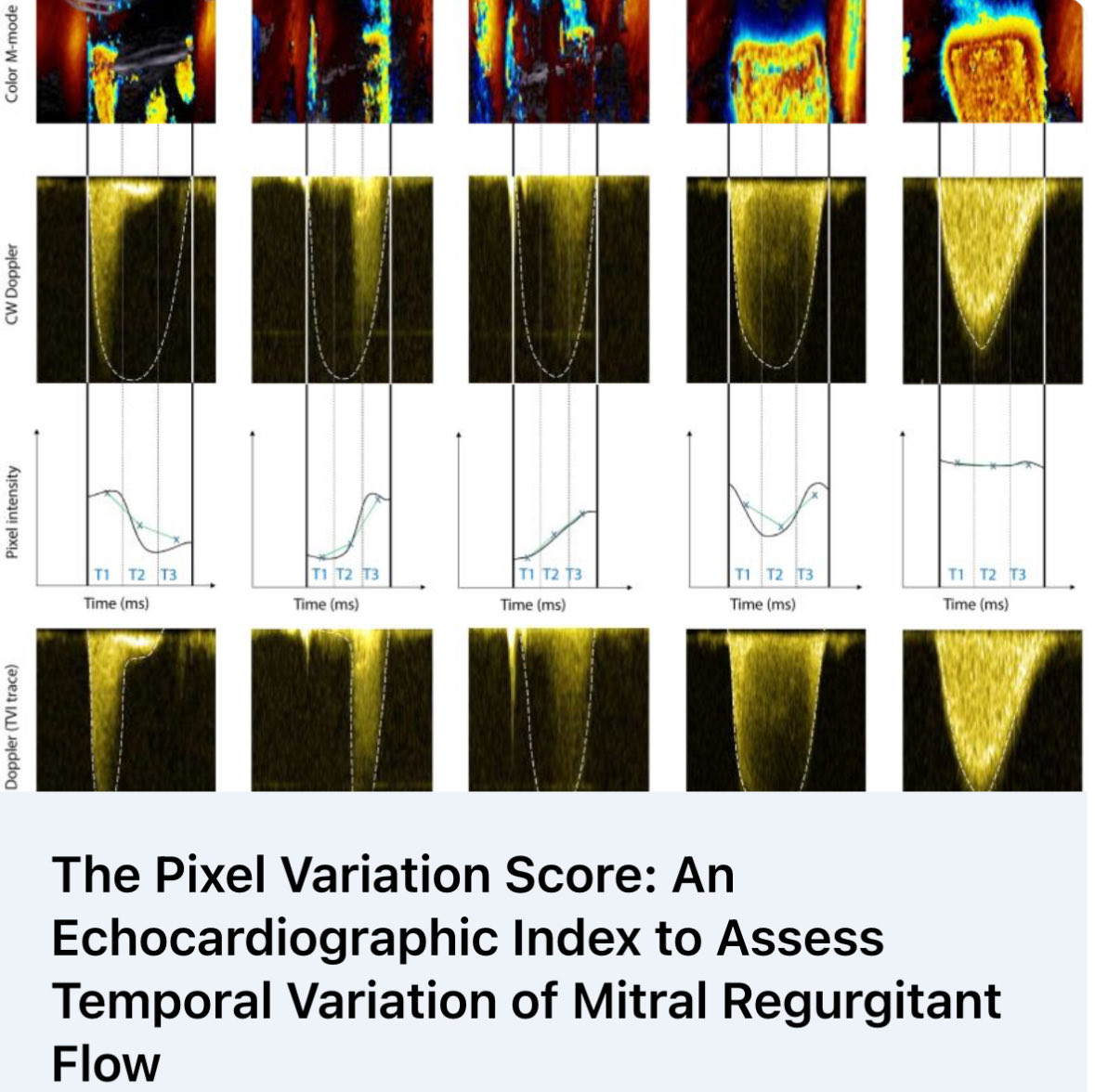 In mitral regurgitation, temporal variation of MR flow has been considered an important reason for inaccurate MR grading.