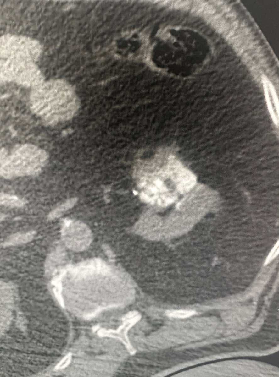 Embolization of endophytic renal cell carcinoma to facilitate same day ablation #iRad