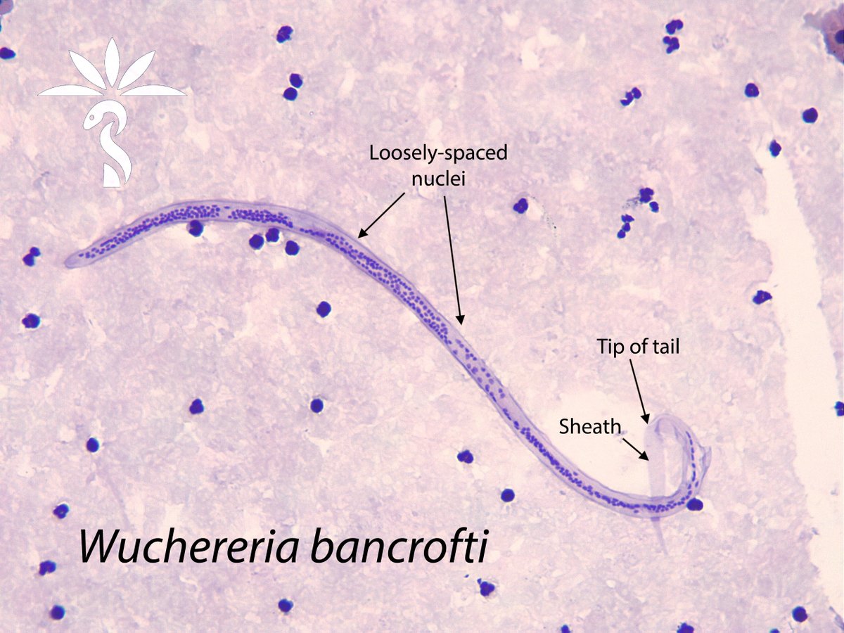 The answer to the #Parasite Case 742 is now up: Wuchereria bancrofti – a classic case! Check out further discussion here: parasitewonders.blogspot.com/2024/03/answer… There are more microfilariae coming your way Idzi Potters and @ITMantwerp! #mayopath #pathology #CrittersOnTwitter #PathBugs