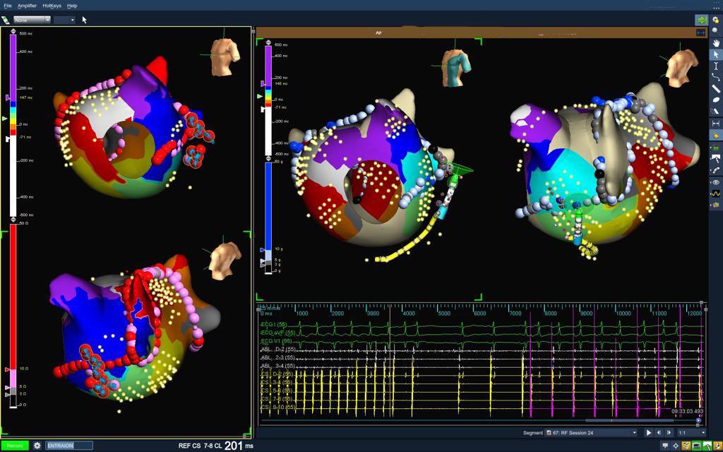 PVI+, induced tachycardia. Mapping and entrainment confirmed 2 distinct alternating left atrial circuits. Ultimately requiring epicardial ablation via Coronary Sinus. #PMA @Ashit_EPS