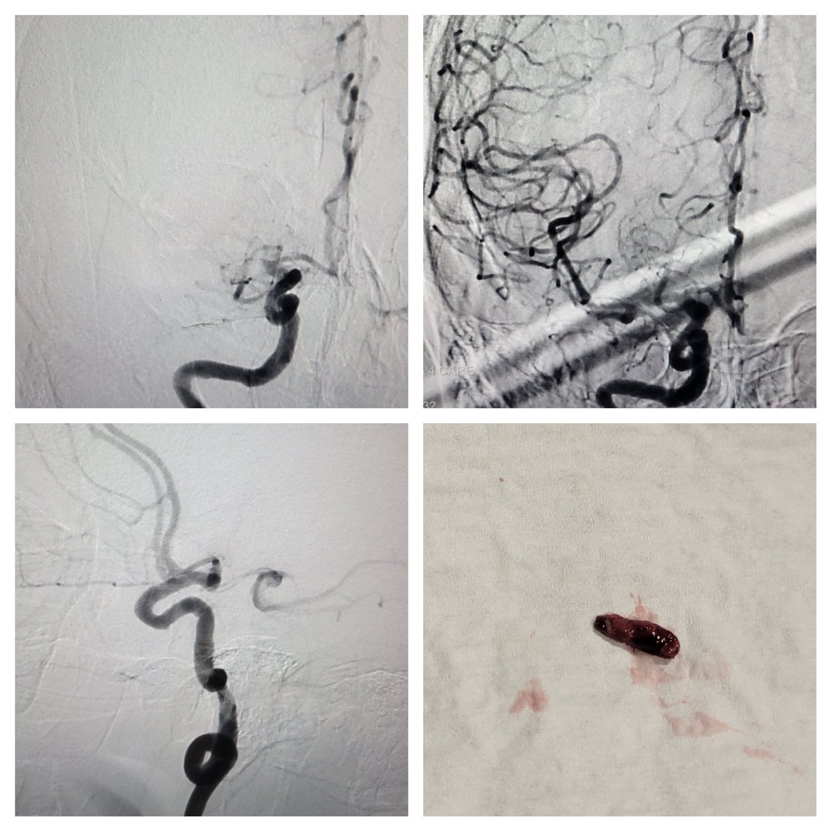 Dan Tonetti (@dantonettimd) on Twitter photo Hey <a href="/route92med/">Route 92 Medical</a> - your FreeClimb088 system takes tortuosity like this cervical loop like a champ! It's incredible how easy it was to get this 088 system to the M1 for #stroke #thrombectomy. Proud to have this capability to so easily help patients <a href="/CooperHealthNJ/">Cooper University Health Care</a> <a href="/CooperNeuroSurg/">CooperNeuroSurg</a> Hey <a href="/route92med/">Route 92 Medical</a> - your FreeClimb088 system takes tortuosity like this cervical loop like a champ! It's incredible how easy it was to get this 088 system to the M1 for #stroke #thrombectomy. Proud to have this capability to so easily help patients <a href="/CooperHealthNJ/">Cooper University Health Care</a> <a href="/CooperNeuroSurg/">CooperNeuroSurg</a>