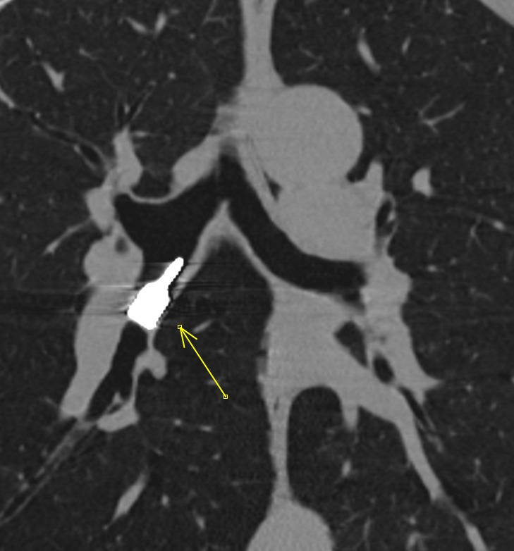 Dry cough for a few weeks. Who can guess what this is?
#radiology #FOAMed #FOAMrad #MedTwitter #emergencyradiology #chestrad #RadTwitter