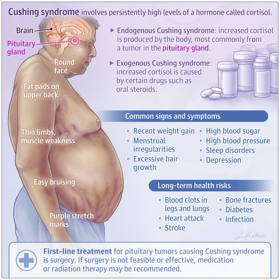 Cushing syndrome involves persistently high levels of a hormone called cortisol. 

This JAMA Patient Page discusses the signs and symptoms, diagnosis, and treatment of Cushing syndrome.

ja.ma/4cv3fch