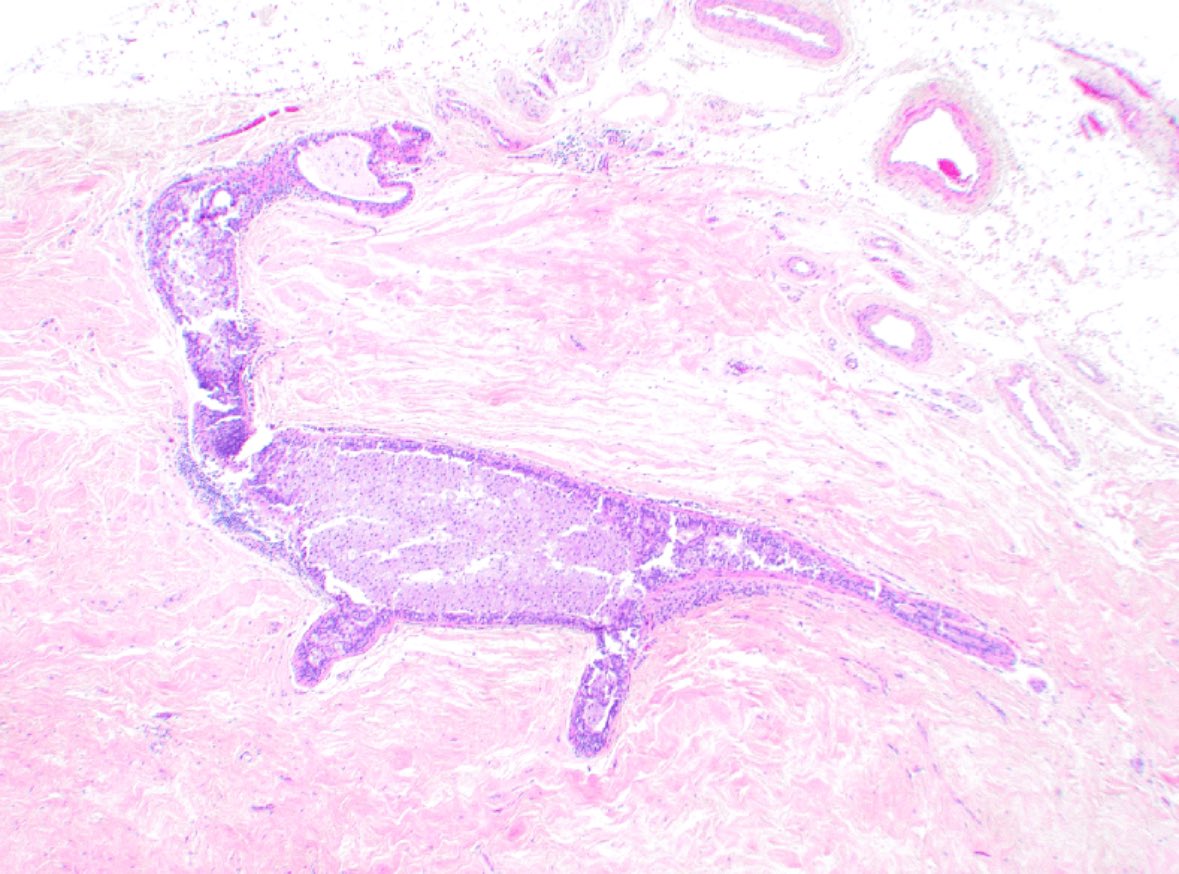 Breast duct ectasia brontosaurus (🦕!) I saw a few weeks ago in a mastectomy. Duct is expanded w/ foamy histiocytes. I don’t have a higher power image, but you can see some lymphoplasmacytic inflammation at the 🦕’s chest and some periductal fibrosis🔬#breastpath #pathology