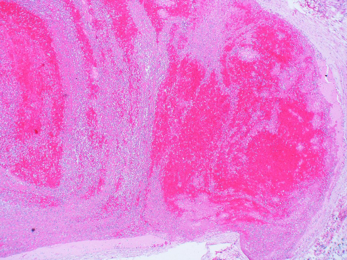 Lines of Zahn are thought to mean antemortem > postmortem clot. Identifying the former can elucidate cause of death, latter not clinically significant We had a recent journal club on an open access article by @ARK_CLE et al 3 key points that I took away (1/) ⬇️