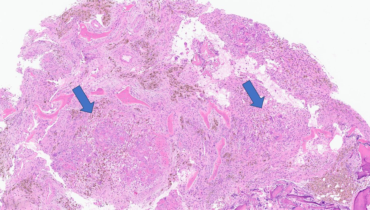 KyleDPerryMD's tweet photo. If everyone suspects metastatic tumor, why am I seeing giant cells? #BSTpath, #UMichPath, #BSTpathGoBlue