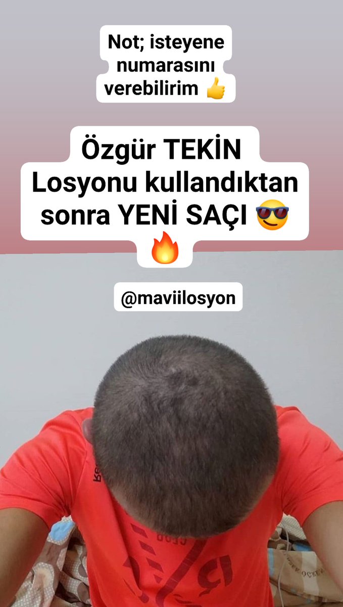 HAYIRLI RAMAZANLAR SAHURLAR 🤲 🌍'NIN HER YERİNE KARGO 👉 A KALİTE 9 KAT ETKİLİ 👉 BAY BAYAN LOSYON 👉 SAÇ DÖKÜLMESİ SON 👉 SAÇLARINIZ YENİDEN ÇIKSIN 👉 💯DE 💯 GARANTİLİ LOSYON #cumartesi #Vtuber