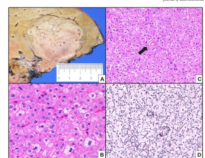 Check out our new paper on hepatic adenoma @JournalofGISurg . The epidemiology is changing and so is the management . Thanks to all the collaborators Link : nam12.safelinks.protection.outlook.com/?url=https%3A%…