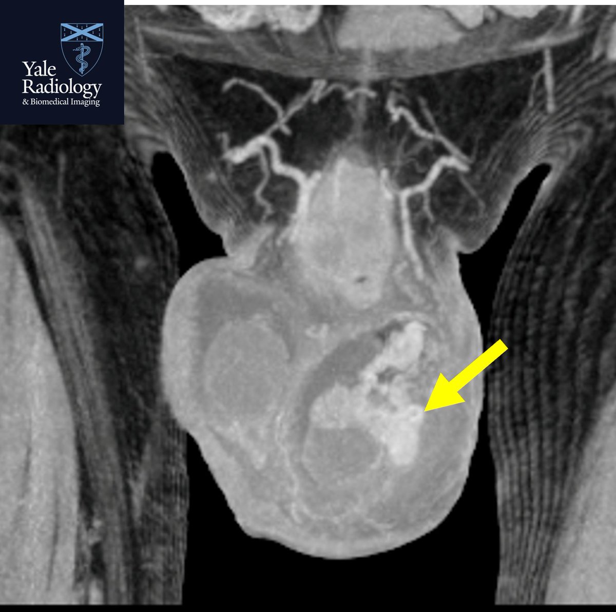 TEACHING COD: not often you’ll see epididymitis on CT! Hyperemic & enlarged L epididymis with surrounding inflammatory change present! #yaleradedu #yaleradiology #FOAMrad #FOAMed #radres #medstudent #radiology @Mahan_Mathur @YaleRadiology #MedTwitter