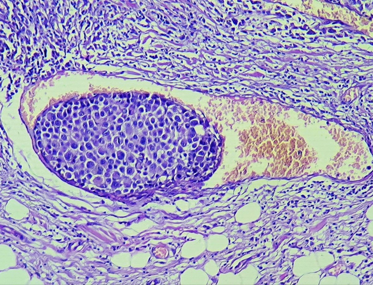 👉 Histopathology image from a case of Malignant melanoma showing vascular invasion in a 35 years old female. Thanks #pathology #PathTwitter #pathoutpic