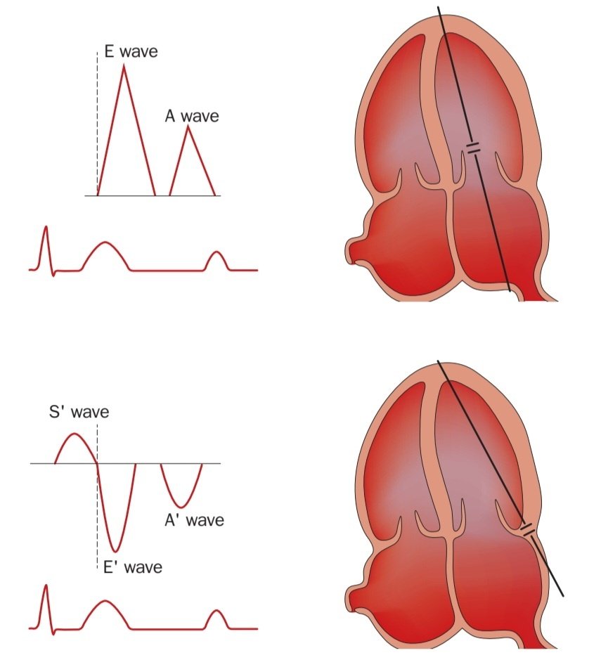 javier20ch's tweet photo. ⚠️Descripción e interpretación de la disfunción diastólica por Ecocardiografía. 🫀💥🧐✍️

🔊Doppler Pulsado:
🔶️La onda E representa el llenado temprano y pasivo del VI, el cual toma lugar en la diástole temprana justo después de la apertura de la válvula mitral. Se debe medir en una posición entre las puntas de las valvas de la válvula mitral con Doppler pulsado.
🔶️La onda A representa el llenado activo de la contracción  auricular, y se mide desde la misma posición que la onda E, con Doppler pulsado.
🔊Doppler tisular:
 ♦️La E' representa la velocidad diastólica temprana del anillo mitral.  Se mide con imágenes Doppler tisular de los lados septal y lateral del anillo mitral.
♦️A' representa la velocidad diastólica tardía del anillo mitral y está relacionado con la contracción auricular.
♦️S' representa la velocidad sistólica del anillo mitral.