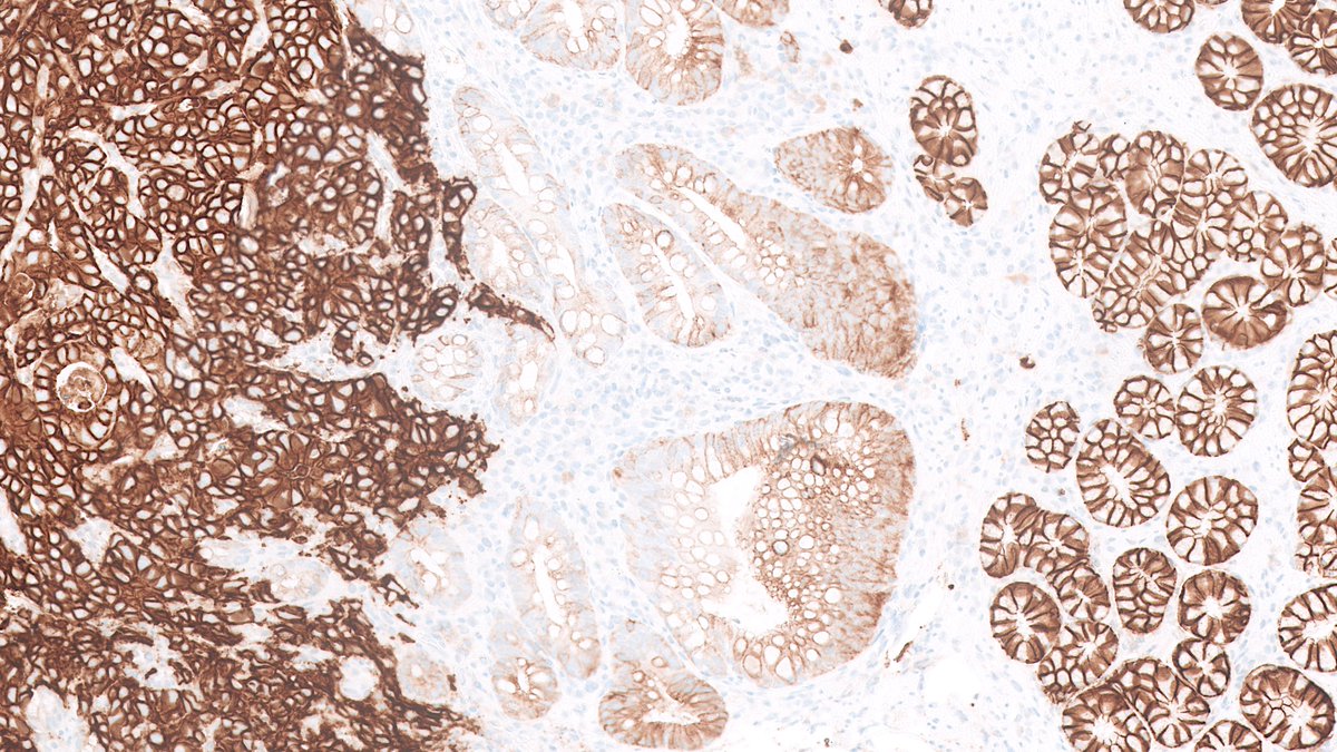 New predictive biomarker for gastric cancer - can you identify it based on this pattern of expression? #GIpath #IHCpath #PathTwitter