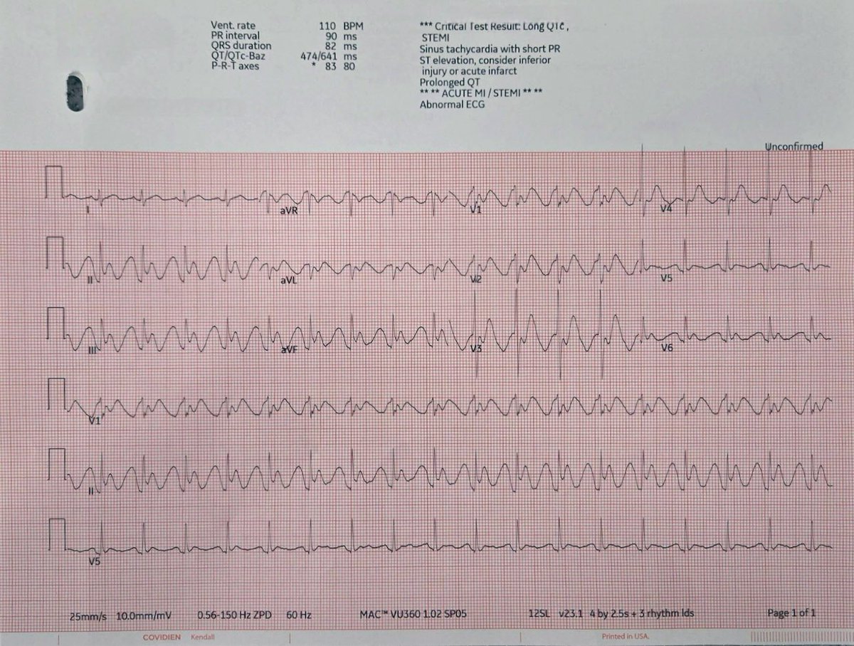 EPheartsEP's tweet image. Here’s another interesting one: 40 y/o M, admitted through ER due to N&amp;amp;V after eating seafood and this EKG. Thoughts? #epeeps #epfellows #Cardiology #CardioTwitter